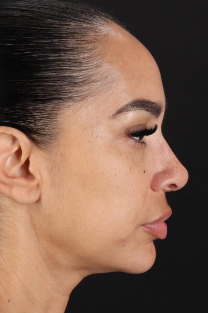 Chin Implant Before & After Patient #11693