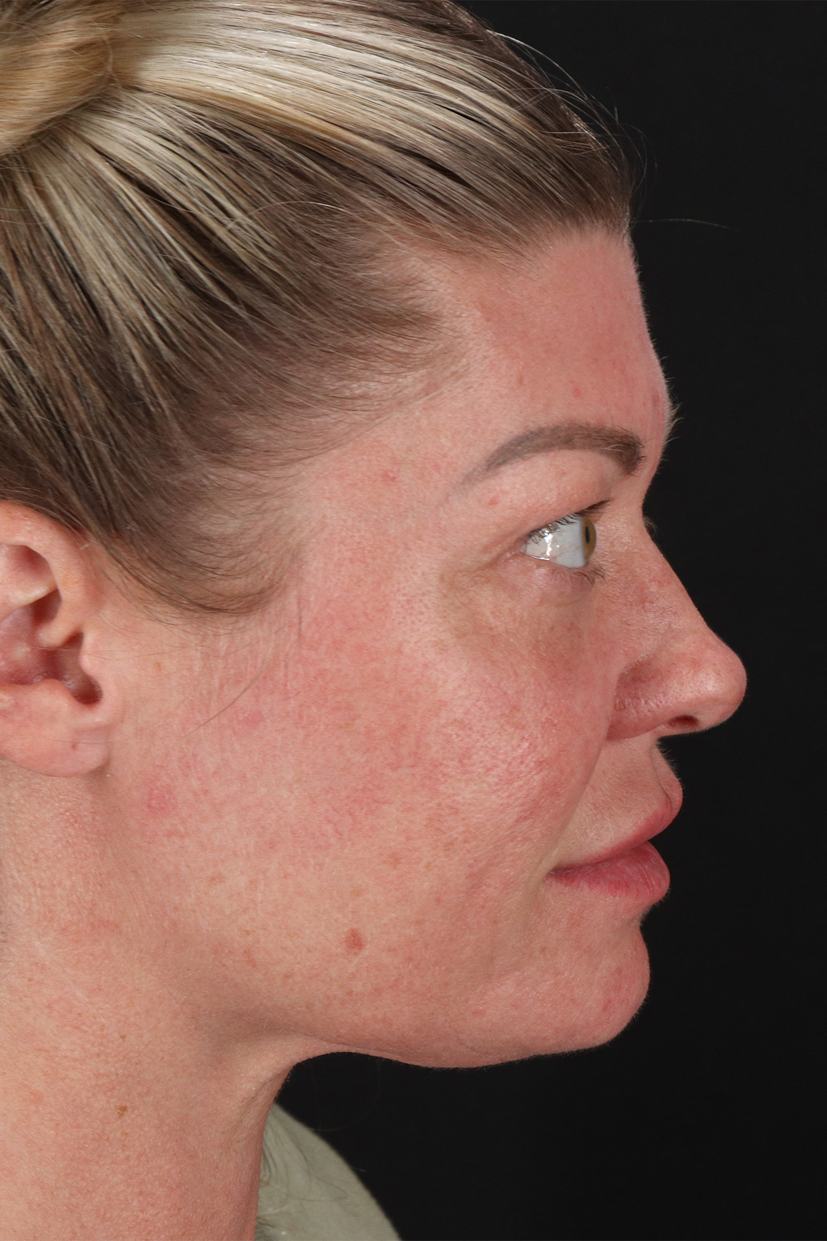 Lower Blepharoplasty Before & After Patient #13030
