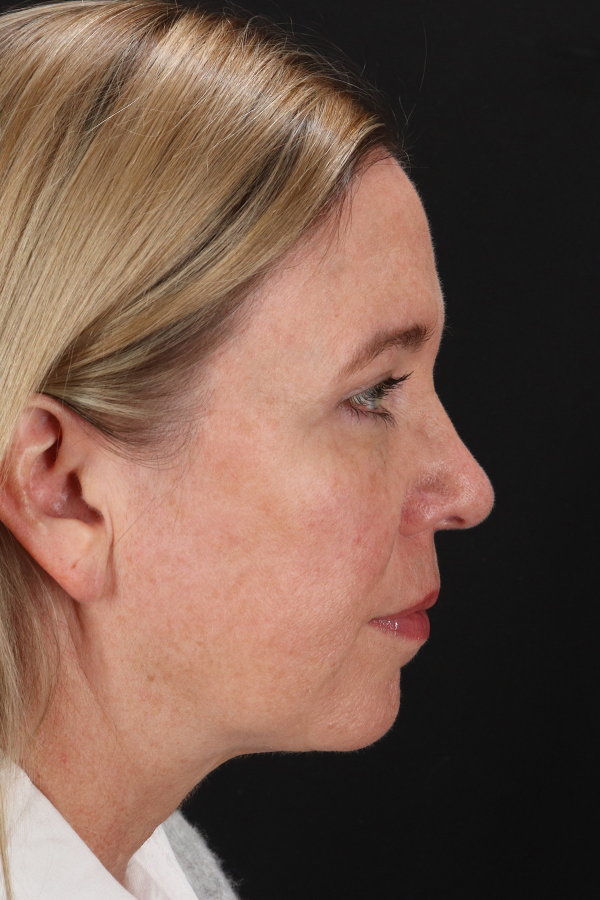 Rhinoplasty Before & After Patient #12194