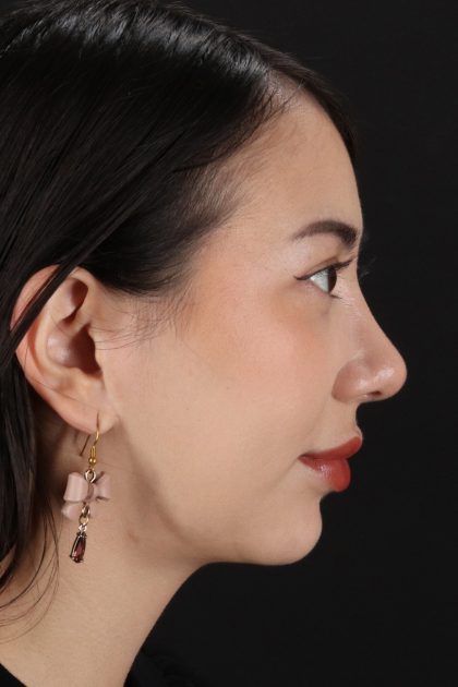 Rhinoplasty Before & After Patient #12359