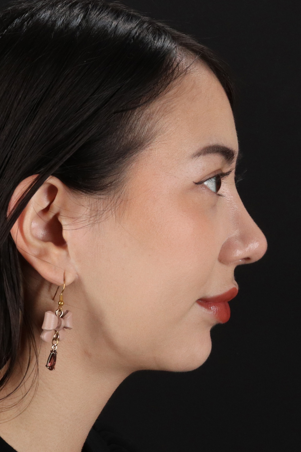 Rhinoplasty Before & After Patient #12359