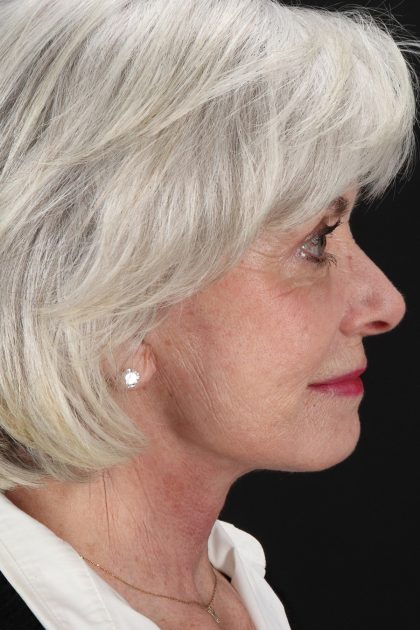 Upper Blepharoplasty Before & After Patient #14036