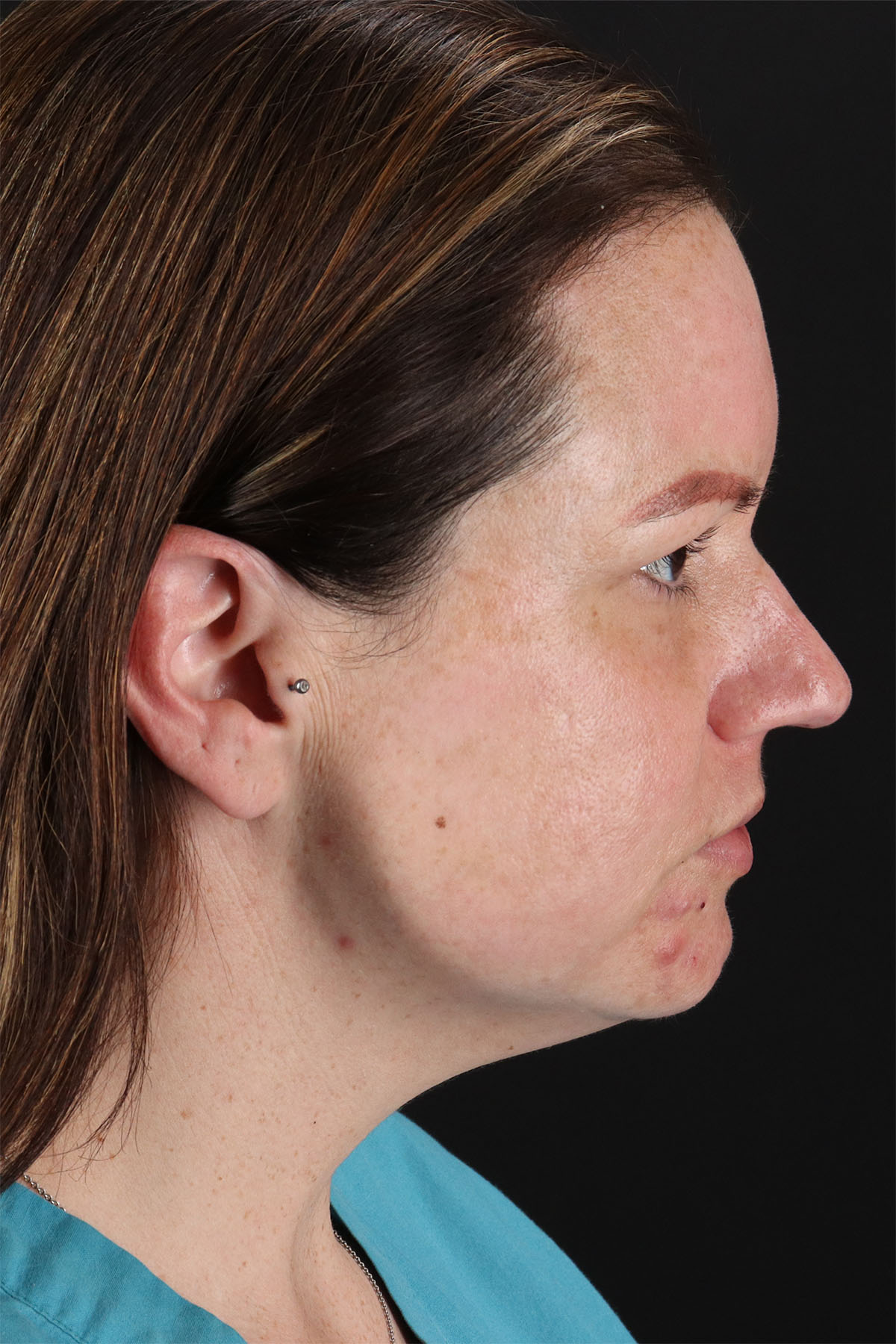 Chemical Peels Before & After Patient #11070