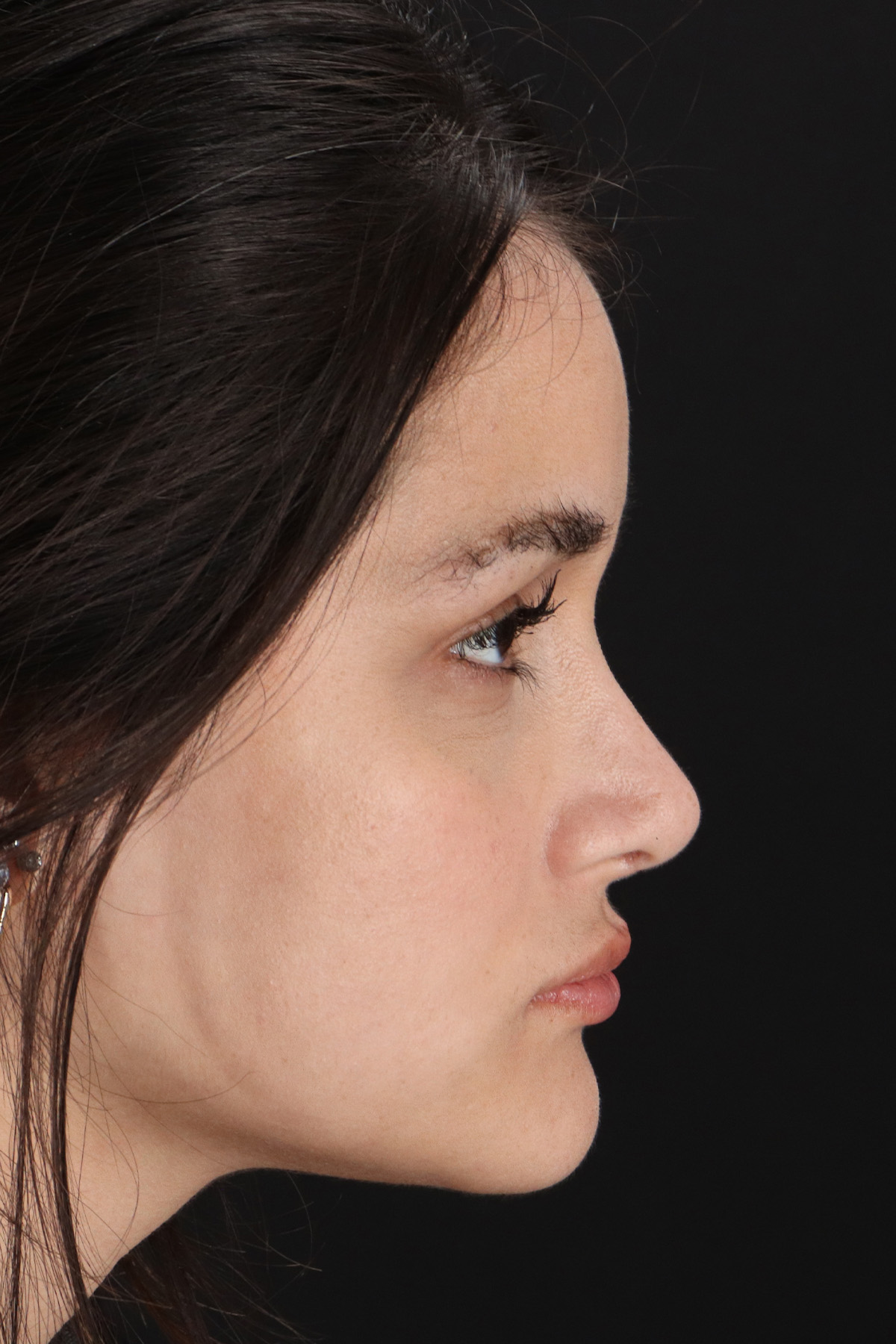 Rhinoplasty Before & After Patient #12260