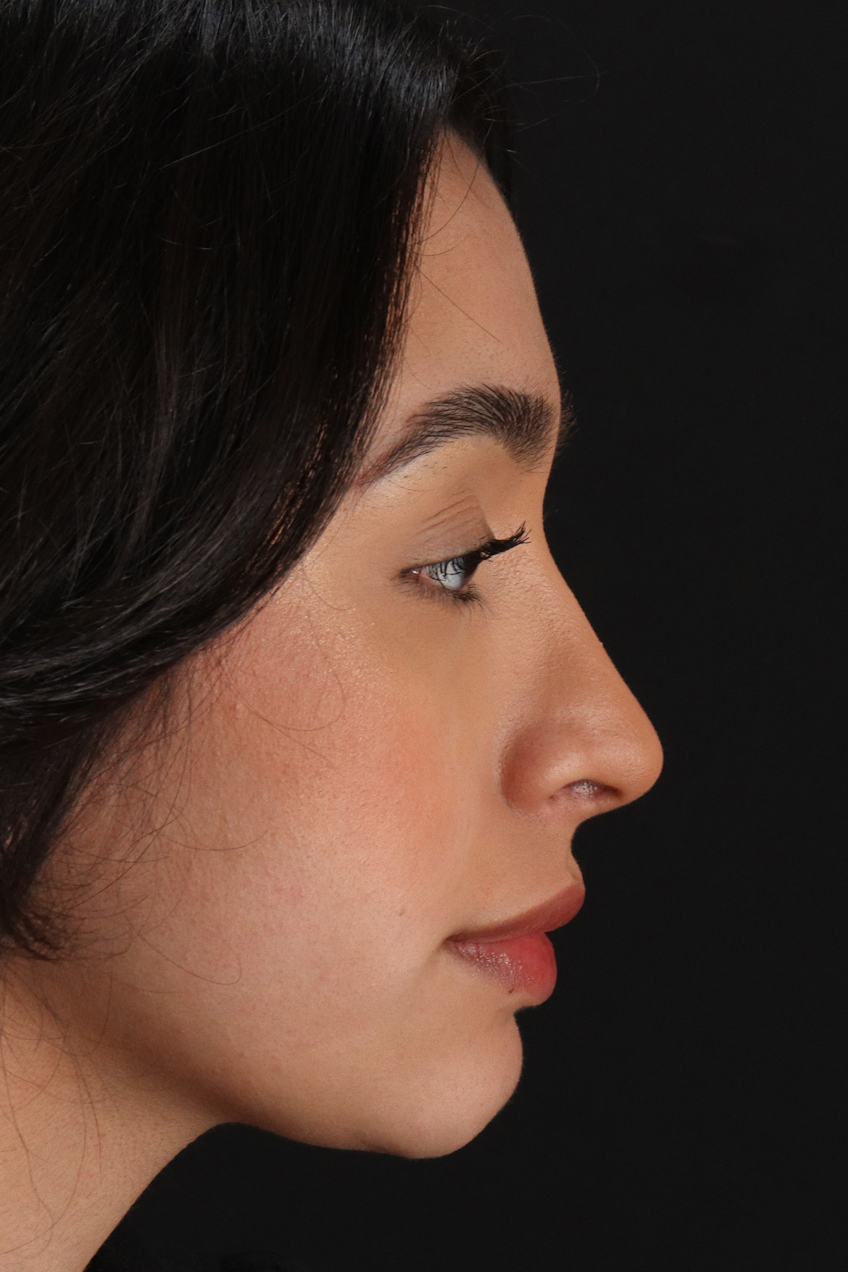 Chin Implant Before & After Patient #13706