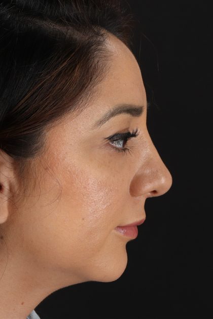 Rhinoplasty Before & After Patient #12392