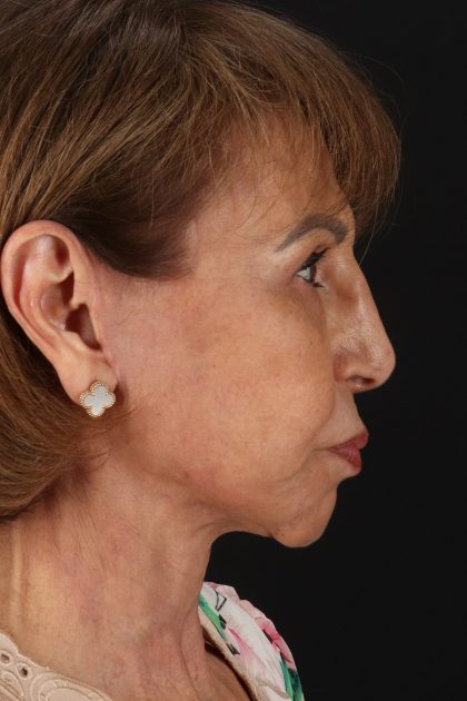 Facelift Before & After Patient #11697
