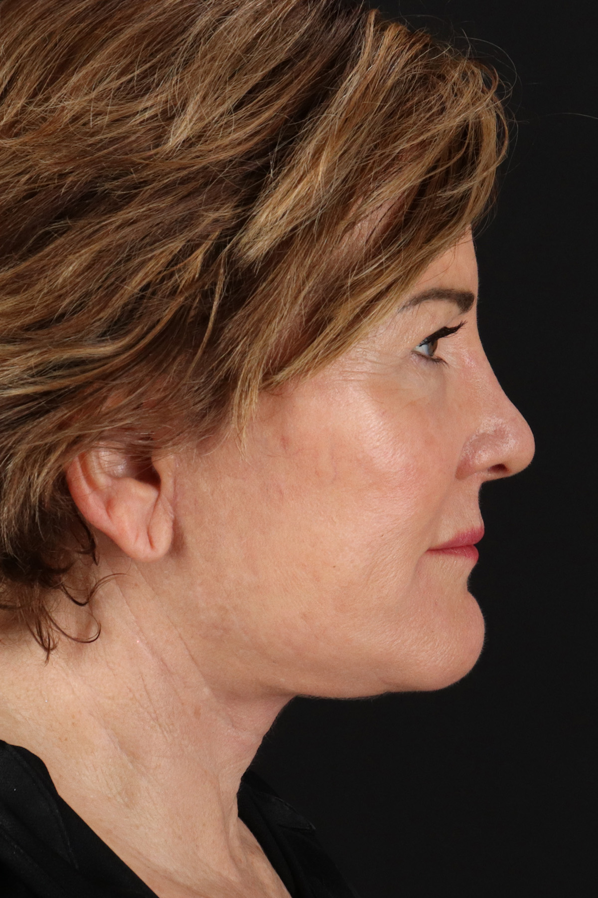 Neck Lift Before & After Patient #10804