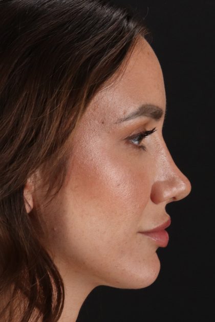 Rhinoplasty Before & After Patient #12370