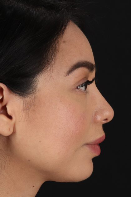 Chin Implant Before & After Patient #13717