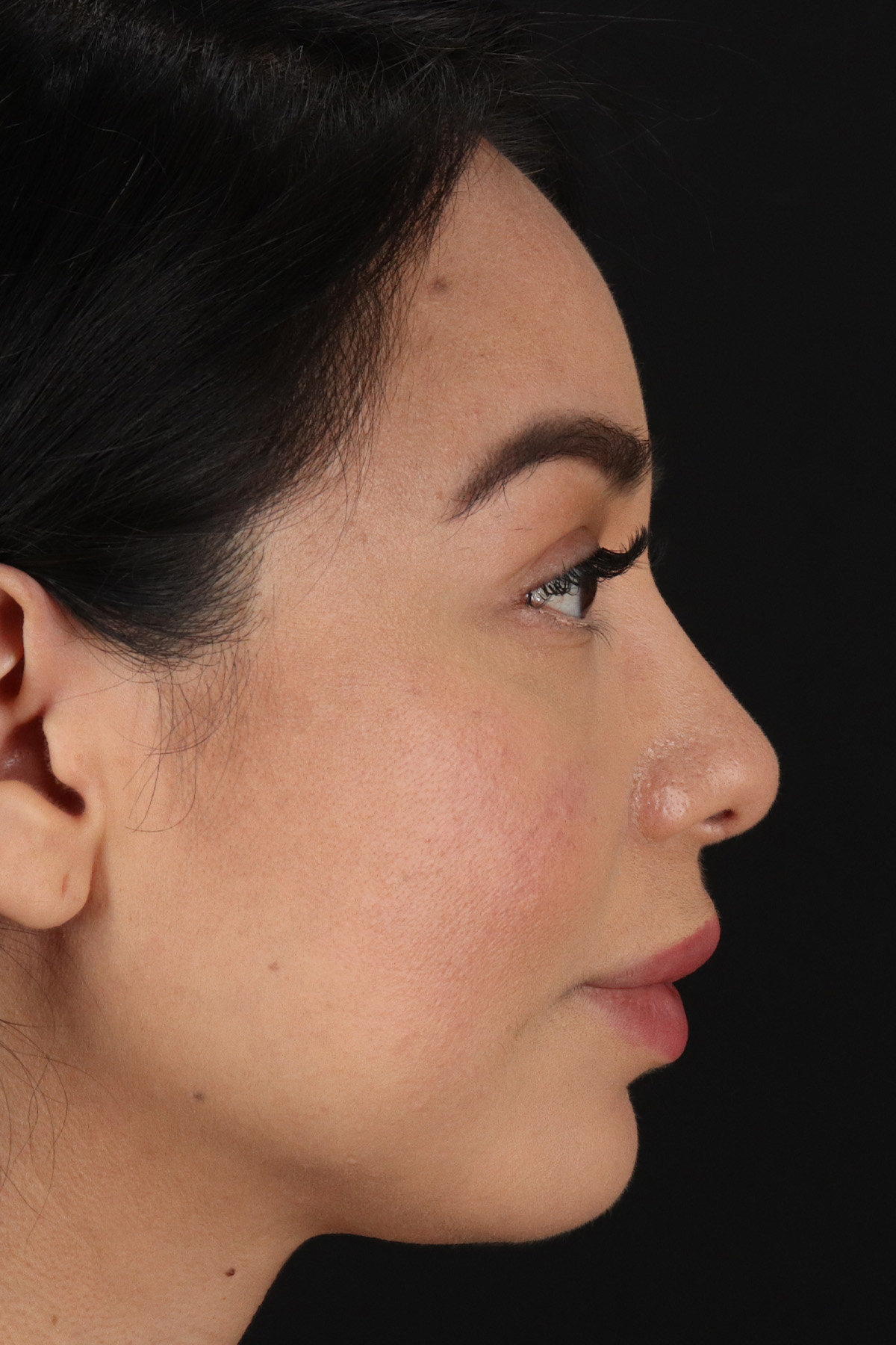 Chin Implant Before & After Patient #13717