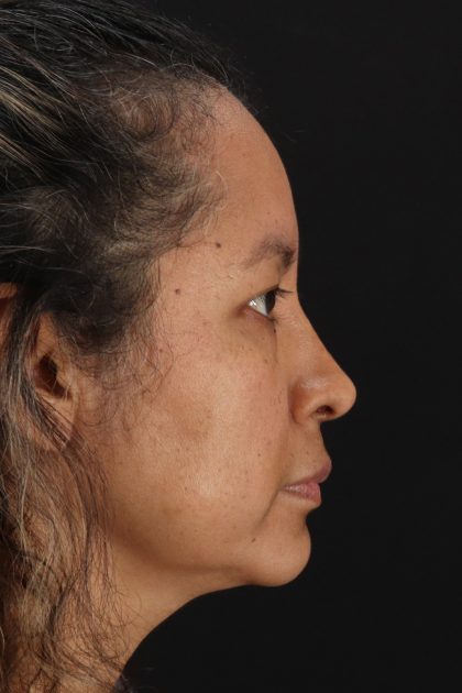 Rhinoplasty Before & After Patient #12293