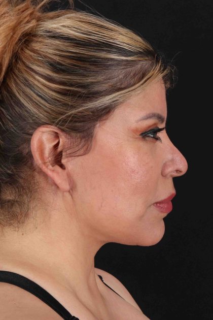 Fat Grafting To The Face Before & After Patient #11850