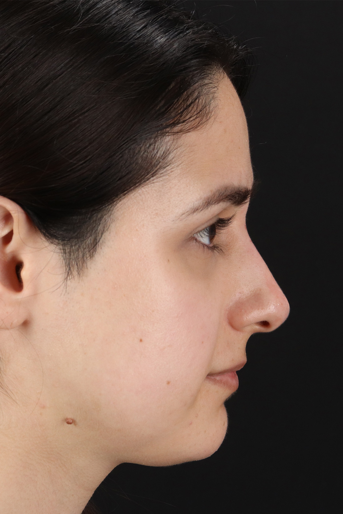 Liquid Rhinoplasty Before & After Patient #11339