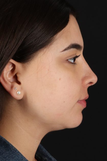 Chin Implant Before & After Patient #11694