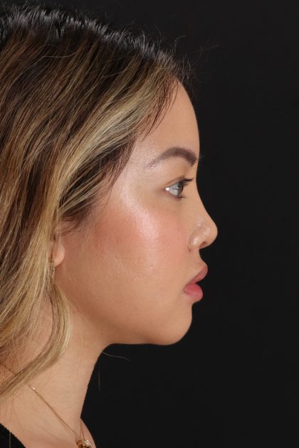 Chin Implant Before & After Patient #13816