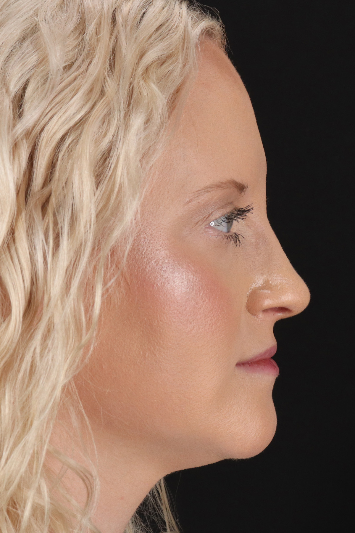 Rhinoplasty Before & After Patient #12381