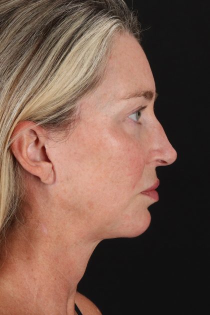 Upper Blepharoplasty Before & After Patient #12084