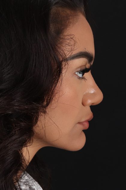 Rhinoplasty Before & After Patient #12326