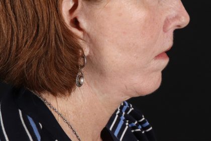 Neck Liposuction Before & After Patient #12117
