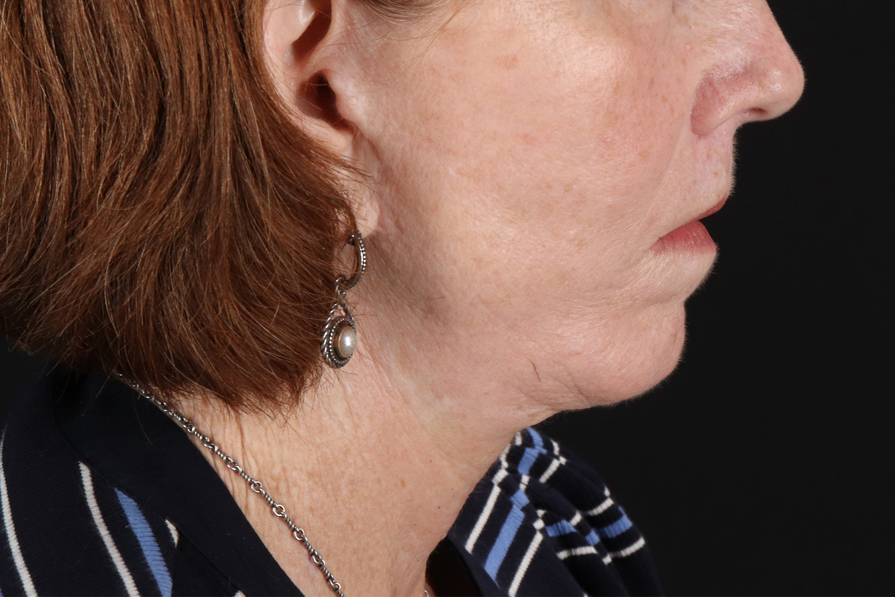 Neck Liposuction Before & After Patient #12117