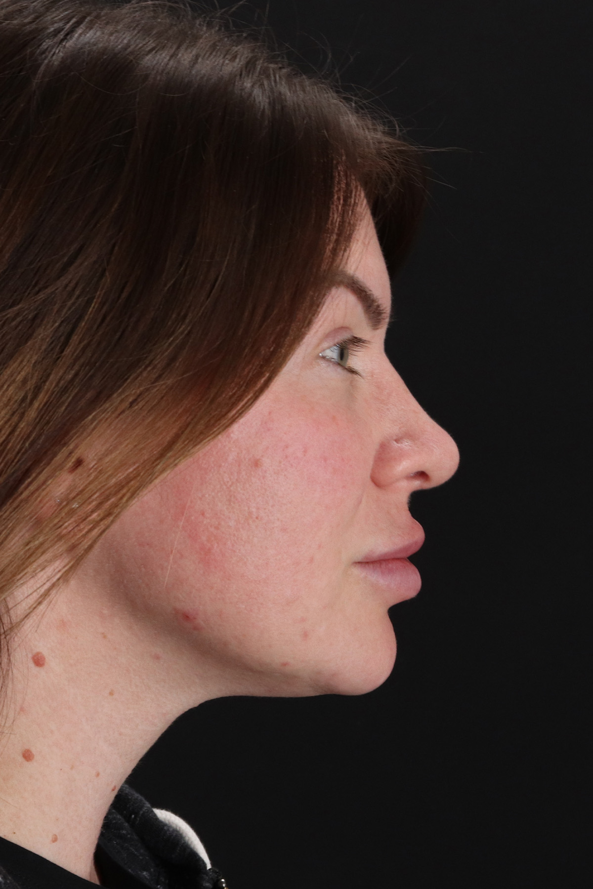 Rhinoplasty Before & After Patient #12414