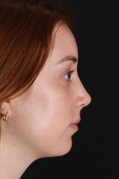 Rhinoplasty Before & After Patient #12348