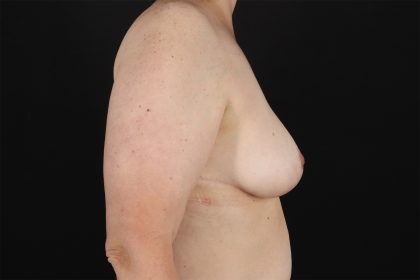 Breast Lift Before & After Patient #11092