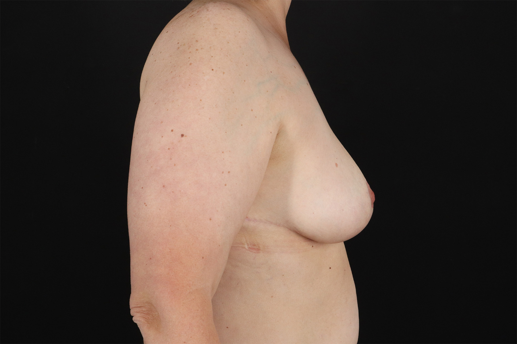 Breast Lift Before & After Patient #11092