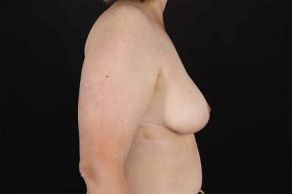 Breast Reduction With Lift Before & After Patient #10969