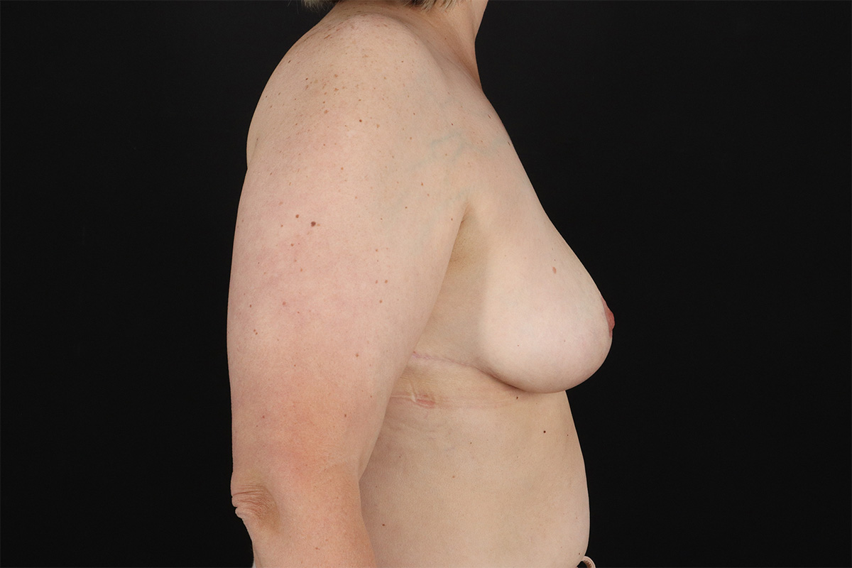 Breast Reduction With Lift Before & After Patient #10969