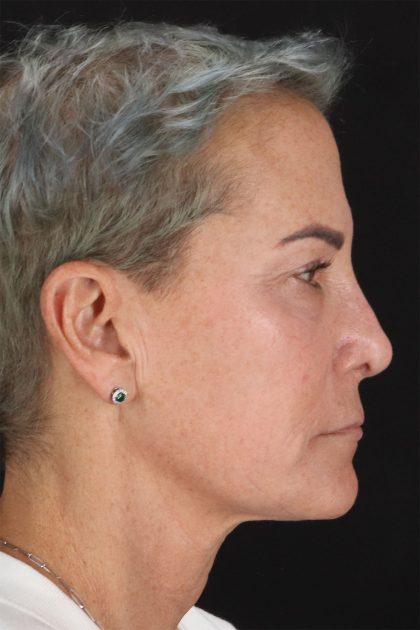 CO2 Laser Before & After Patient #10980