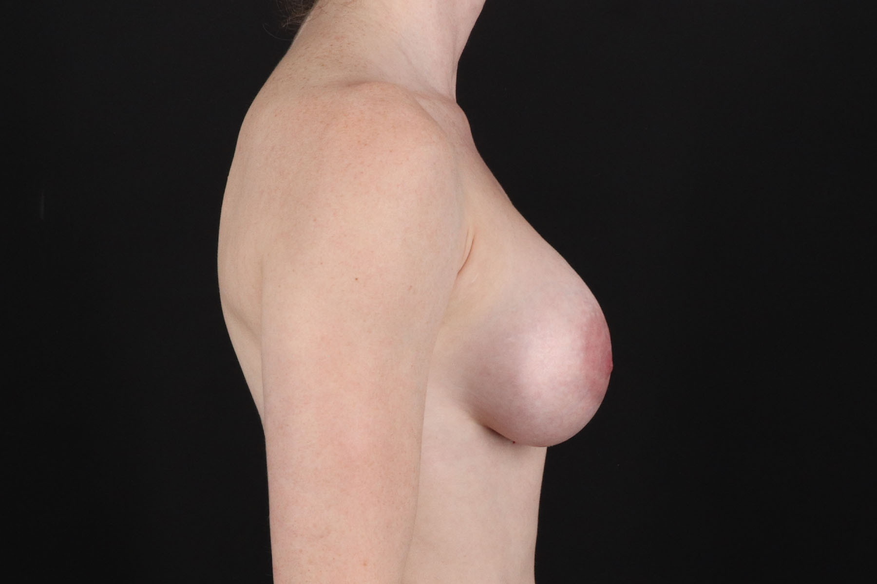Breast Augmentation with Implants Before & After Patient #10892