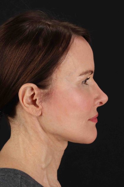 Fat Grafting To The Face Before & After Patient #11839