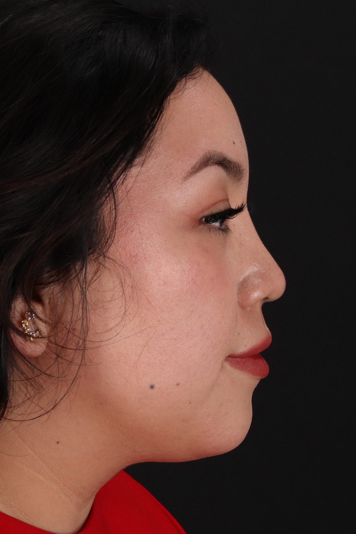 Rhinoplasty Before & After Patient #12447