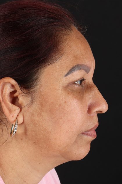 Lower Blepharoplasty Before & After Patient #13085