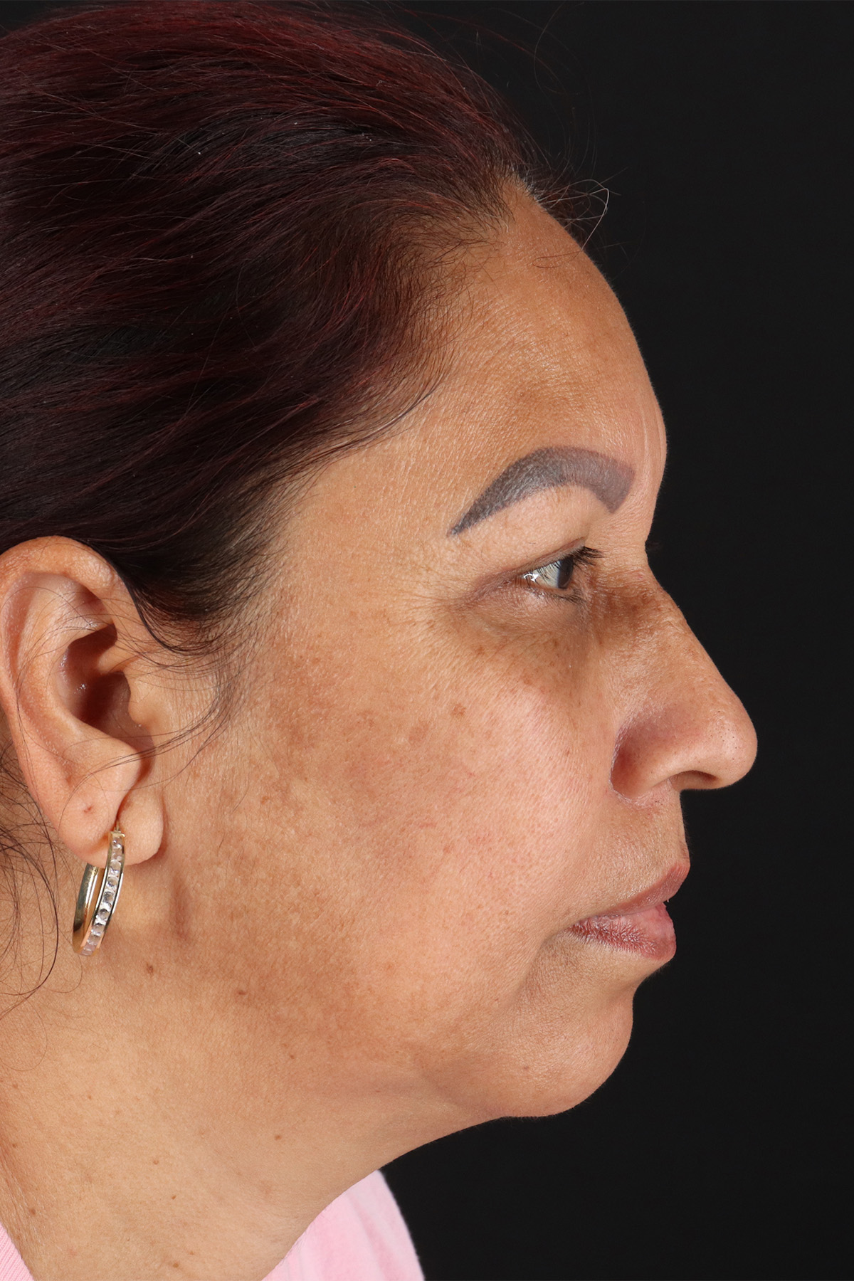 Upper Blepharoplasty Before & After Patient #12051