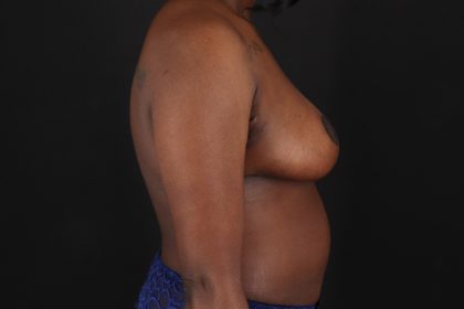 Breast Reduction With Lift Before & After Patient #11440