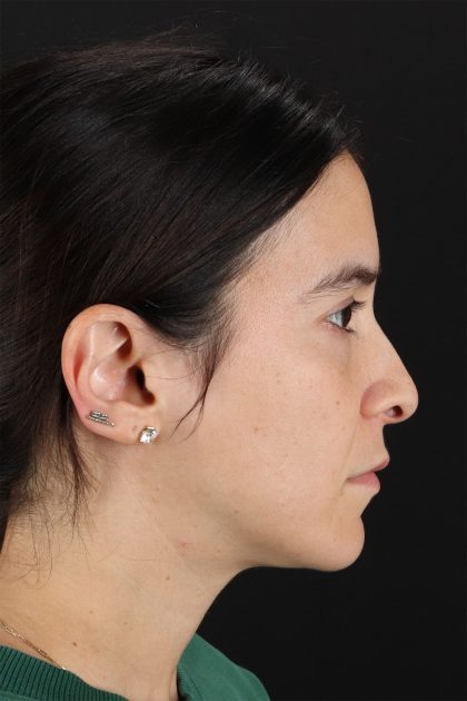 CO2 Laser Before & After Patient #11103