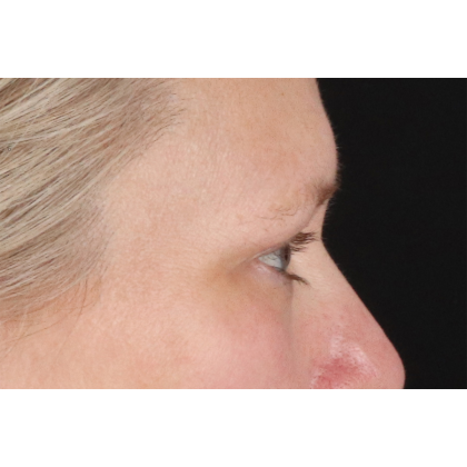 Blepharoplasty (Eyelid Surgery) Before & After Patient #10991
