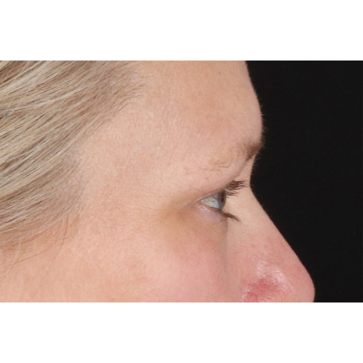 Blepharoplasty (Eyelid Surgery) Before & After Patient #10991