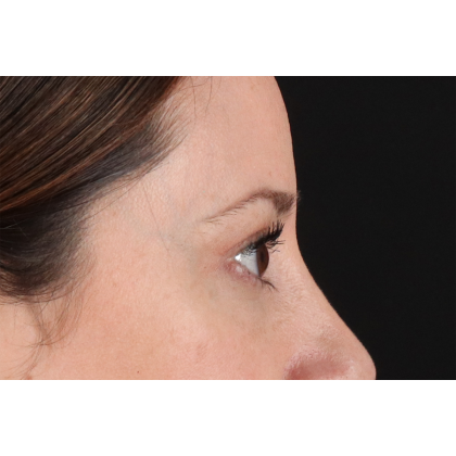 Blepharoplasty (Eyelid Surgery) Before & After Patient #11114