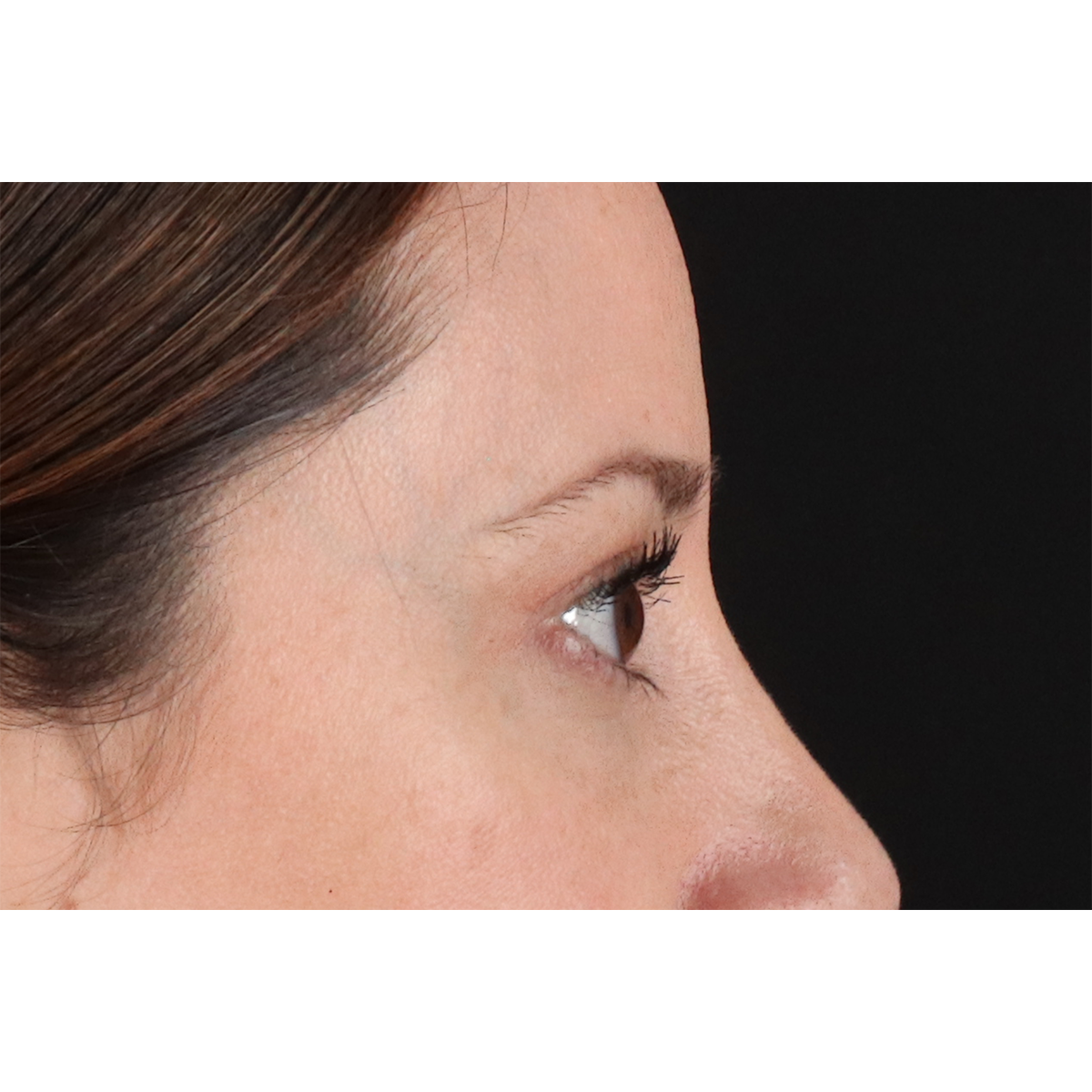 Blepharoplasty (Eyelid Surgery) Before & After Patient #11114