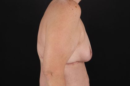 Breast Reduction With Lift Before & After Patient #10925