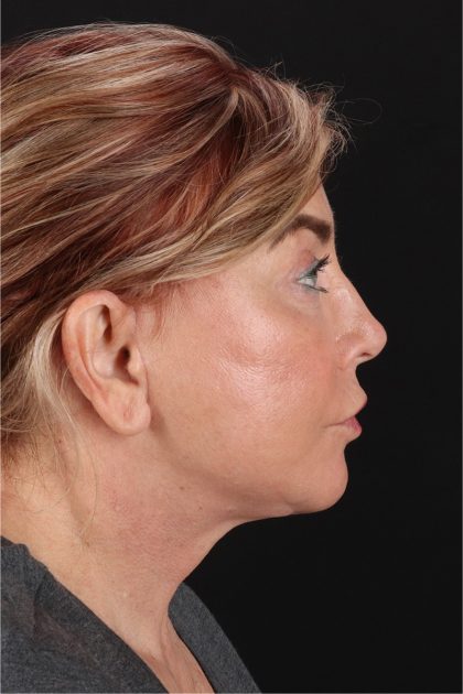 Fat Grafting To The Face Before & After Patient #11828