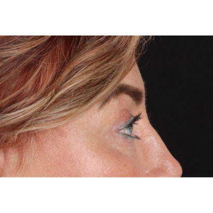 Blepharoplasty (Eyelid Surgery) Before & After Patient #11506
