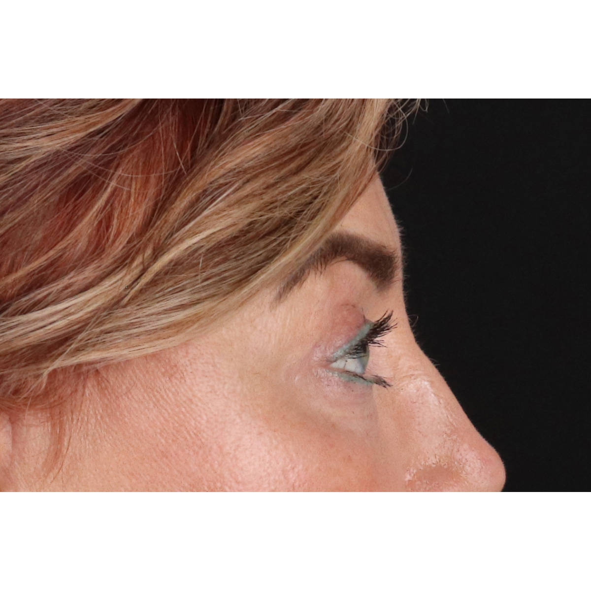 Blepharoplasty (Eyelid Surgery) Before & After Patient #11506