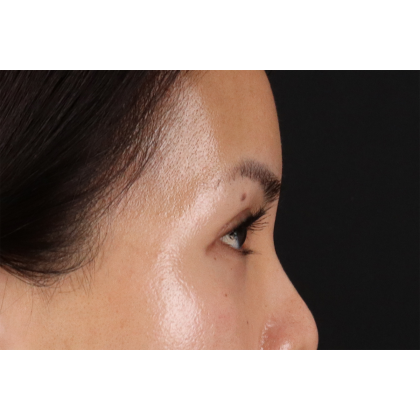 Blepharoplasty (Eyelid Surgery) Before & After Patient #10782