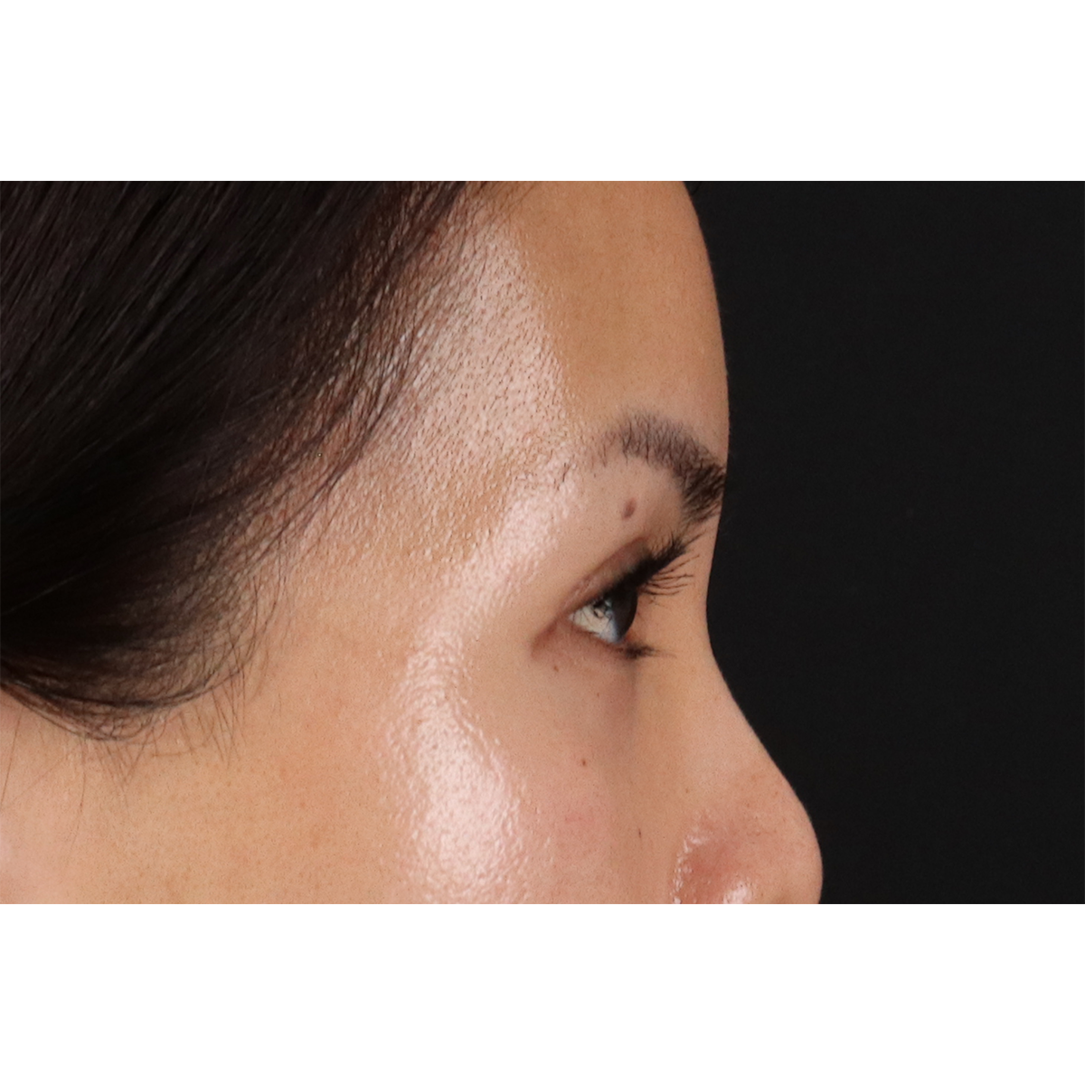 Blepharoplasty (Eyelid Surgery) Before & After Patient #10782