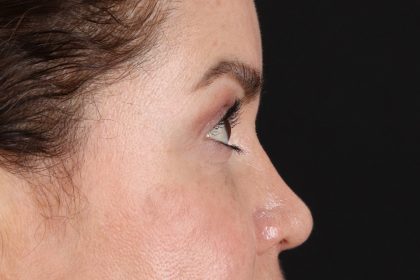 Rhinoplasty Before & After Patient #12656